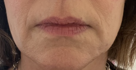 Saggy mouth and jaw help needed (pic attached)