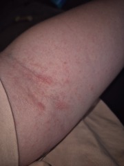 Rash all over breasts and torso