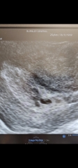 Pregnancy of uncertainty viability