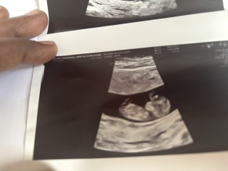 Can anyone help me it’s boy or girl 12 week scan