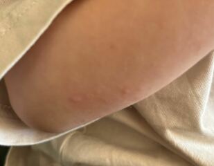 Rash on toddler ??