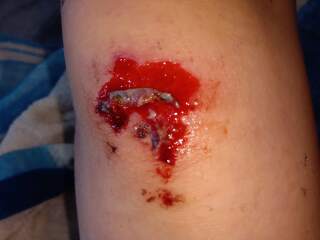 Does my son’s knee scrape look infected?