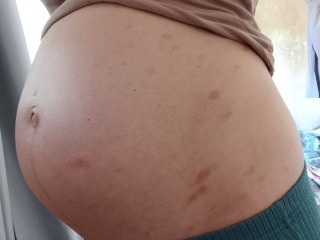 Help! What is this itchy pregnancy rash? (Pics)