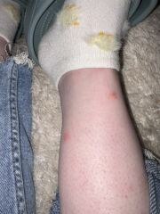 Bites or hives??