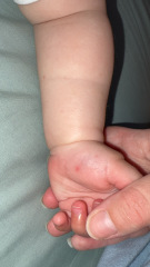 Heat rash? Teething rash? Hand, foot & mouth?