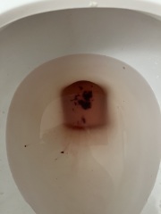 Threatened miscarriage?