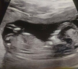Gender guess for twins??