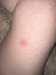 Bites or hives??