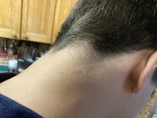 Barber scratched neck