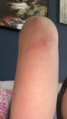 Is this shingles