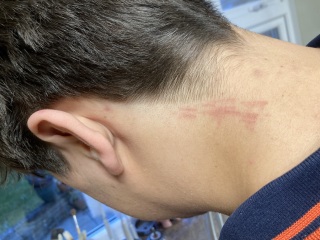 Barber scratched neck