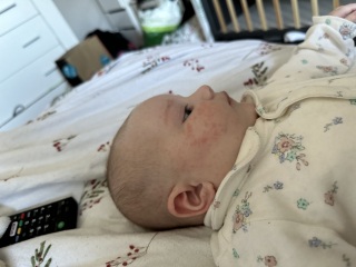 3 month old baby acne?