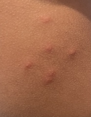 What is this rash?