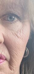 Tretinoin - for fine lines and wrinkles at 58?