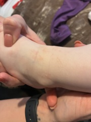 Is this chicken pox or HFM or something else?