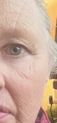 Tretinoin - for fine lines and wrinkles at 58?