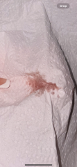 Tmi pic - implantation bleeding or period?