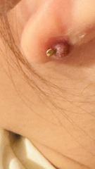 4 year old lump back of ear after piercing