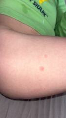 Another chicken pox one…