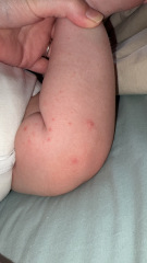 Heat rash? Teething rash? Hand, foot & mouth?