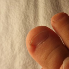 Ingrown toenail