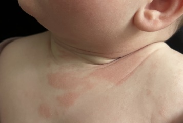 Any rash experts on here?