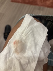 Bleeding very early pregnancy