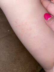 Rash - any thoughts?