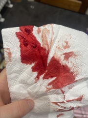 Bleeding and blood clotting 14 weeks pregnant