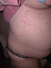 Rash all over breasts and torso