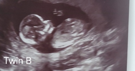 Guess the Sex of my Twins??