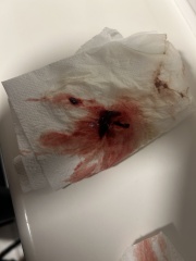 Is this a miscarriage? 14 weeks and clots? Picture