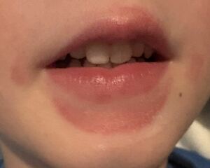 Rash around mouth of 4 year old