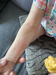 Erythema Multiforme?