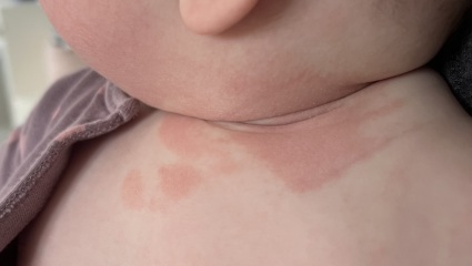 Any rash experts on here?