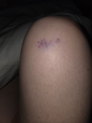 Bruise