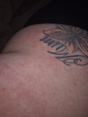 Rash all over breasts and torso