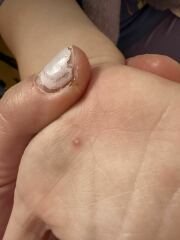 Is this a wart on hand ?!