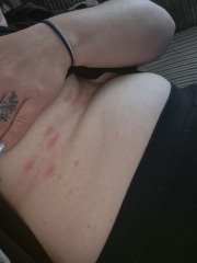 Pityriasis rosea