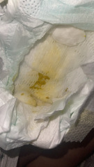 Possible cows milk allergy
