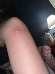 Is this shingles