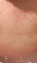 Viral rash