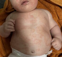 Rash! need help identifying