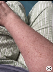 Fed up with keratosis pilaris