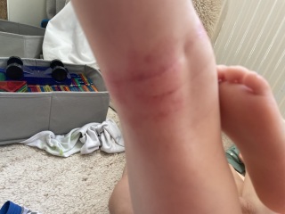 Eczema - should I use steroid cream now?