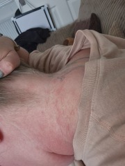 Rash all over breasts and torso