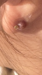 4 year old lump back of ear after piercing