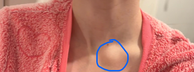 Lump question