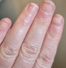 Pale fingernails