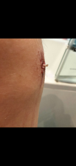 Are there any nurses / medical people here? What is this? *Warning, photo attached
